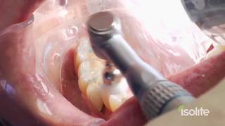 Dental Restoration with Isolite [upl. by Ennylhsa279]