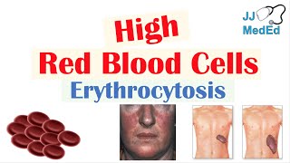 High Red Blood Cells Erythrocytosis  Causes Signs and Symptoms and Treatment [upl. by Bill]