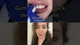 What Is Gum Recontouring For [upl. by Igiul]