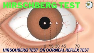 Hirschberg Corneal Reflex Test Principles and Procedure [upl. by Alaunnoif]