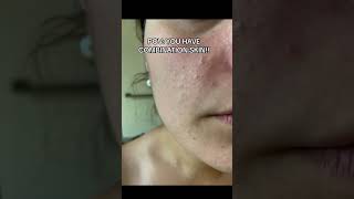 Do you have COMBINATION SKIN skincare skincareroutine [upl. by Nyrmak]