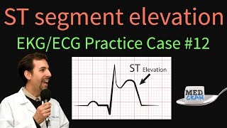 ST Elevation  EKG  ECG Interpretation Case 12 STEMI MI ACS [upl. by Tertia]