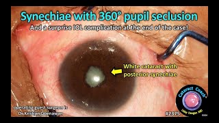 CataractCoach™ 2375 synechiae with 360 degree pupil seclusion [upl. by Janelle]