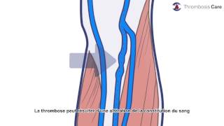 la thrombose veineuse profonde [upl. by Anieral]