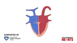 Tetralogy of Fallot [upl. by Ecital173]