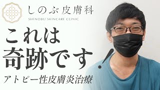 【アトピー性皮膚炎】奇跡の治療法で人生が変わった｜IgEが18000｜デュピクセント [upl. by Llerdnek]