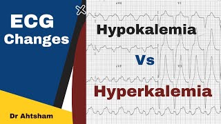 ECG findings Hypokalemia vs Hyperkalemia  Dr Ahtsham [upl. by Selina]