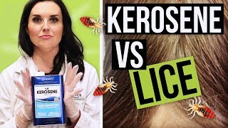 Kerosene For Head Lice Removal  Watch BEFORE YOU TRY [upl. by Tegdig]