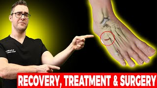 5th Metatarsal Jones Fracture Recovery Treatment amp Surgery [upl. by Sidran663]