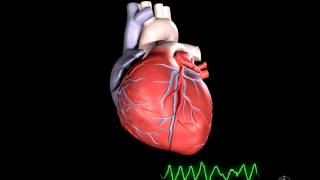 What is Ventricular Fibrillation [upl. by Suoivatnod]