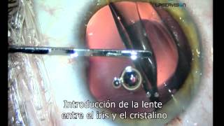 Lente intraocular para el tratamiento de la miopia hipermetropia y astigmatismo [upl. by Farrow653]