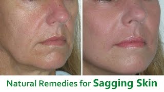 The Best 5 Natural Remedies for Sagging Skin [upl. by Laden490]