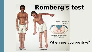 Rombergs test [upl. by Combes]