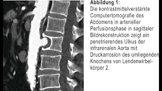 Kolikartige Flankenschmerzen bedingt durch symptomatisches Aortenulkus [upl. by Htiekal454]