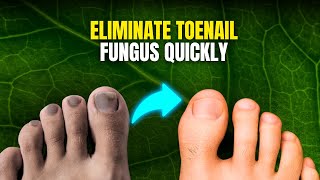 Eliminate Toenail Fungus Quickly Fast and Natural Solutions [upl. by Atilrahc]