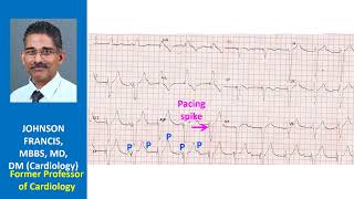 Findings and conclusion for this ECG [upl. by Torrie]