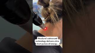 The Fastest Easiest and Most Advanced Laser Tattoo Removal at SCMS [upl. by Odrareve]