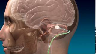 Deep Brain Stimulation for Stroke Recovery Animation [upl. by Litnahc]