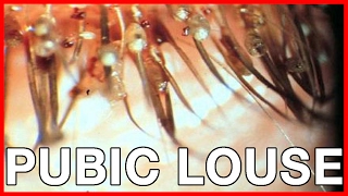 Crabs or Pubic Louse Early Symptoms Cure Risks Pictures [upl. by Adalbert]