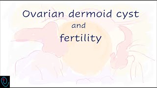 Ovarian dermoid cyst and Fertility [upl. by Gisella714]