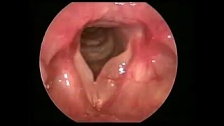 聲帶水腫息肉 Reinkes edema with vocal polyp [upl. by Naam]