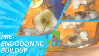 Pre Endodontic BuildUp [upl. by Nirda16]