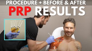 PlateletRich Plasma PRP Injections  Shoulder Impingement Rotator Cuff Injury Treatment Results [upl. by Bridie]