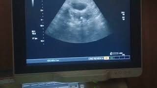 Osseous metaplasia uterus pelvicultrasound pathology [upl. by Dnomzed]