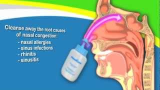 Nasal Irrigation to Treat Sinusitis Common Cold Allergy Better Than Neti Pots [upl. by Llerrem422]