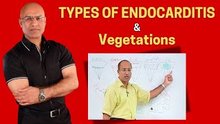 Endocarditis Types and Vegetations  Cardiology🫀 [upl. by Aelber]