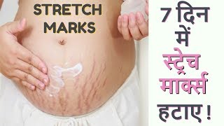 7 दिन में Stretch Marks को ख़त्म कर Baby Soft त्वचा पाने का अचूक उपाय Stretch Marks removal at home [upl. by Aleet]