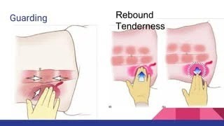 Differences between Rebound Tenderness and Muscle Guarding During Palpation [upl. by Noyek]