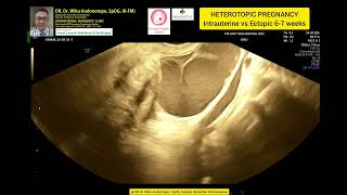 Heterotopic Pregnancy  Intrauterine normal 6 weeks vs Ruptured Ectopic Pregnancy [upl. by Disharoon]