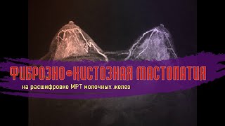 ФИБРОАДЕНОМА молочной железы BI RADS 3 и МАСТОПАТИЯ фибрознокистозная на расшифровке МРТ 2 мнение [upl. by Enyrb]