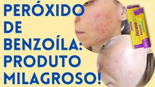 Peróxido de Benzoíla  Produtos para Acne que FUNCIONAM EP 01 🙌🏻 [upl. by Burrton821]