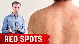 Why Red Spots on My Skin – DrBerg on Skin Red Spots Causes amp Remedies [upl. by Davison]