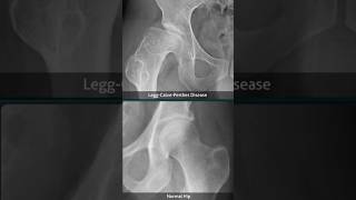 LeggCalvePerthes Disease Xray 1 [upl. by Roarke]