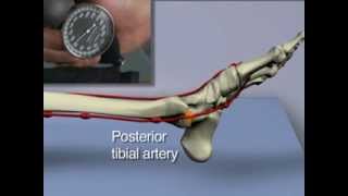 AnkleBrachial Index for Assessment of Peripheral Arterial Disease [upl. by Neenwahs]