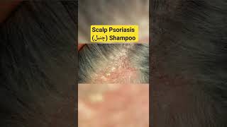 Etrivex Shampoo For scalp Psoriasis  How to use Etrivex shampoo psoriasis seborrheicdermatitis [upl. by Alexandria]