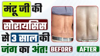 सोरायसिस से 3 साल की जंग का अंत  Psoriasis Ka Ilaaj  Psoriasis Treatment psoriasistreatment [upl. by Ardnasirhc]