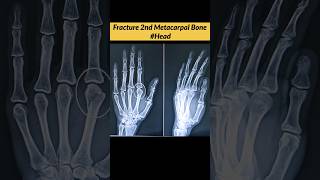 FRACTURE 2nd Metacarpal Bone oF Hand radiographerusn radiography radiographer xray [upl. by Icyaj667]