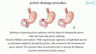 pyloric drainage procedure [upl. by Aran]