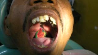 Dr Pankaj Kharade Pharyngeal obturator impression [upl. by Acirret887]