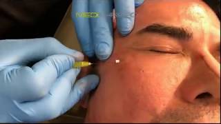 PDOTHREAD LIFT PROCEDURE BY MEDiTHREAD  Eyes [upl. by Lurline]