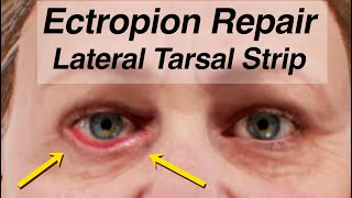 Ectropion Repair Using a Lateral Tarsal Strip Lower Eyelid Drooping After Facial Paralysis [upl. by Asille]