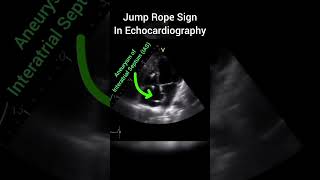 Aneurysm of InterAtrial Septum  Jump Rope sign in Echocardiography [upl. by Philly]