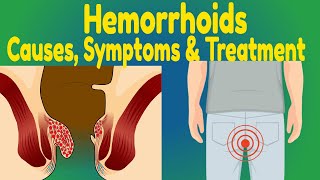 Hemorrhoid Relief What ACTUALLY Works for Internal amp External Hemorrhoids [upl. by Fishback952]