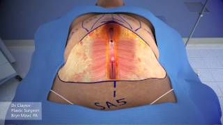 Dr Claytor Demonstrates Drainless Tummy Tuck with Liposuction  3D Animation [upl. by Tawsha459]