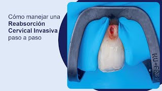 Cómo manejar una reabsorción cervical invasiva paso a paso [upl. by Akimet]