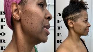 Facial Tiny Mole Removal Dermatosis Papulosa Nigra [upl. by Leacock]